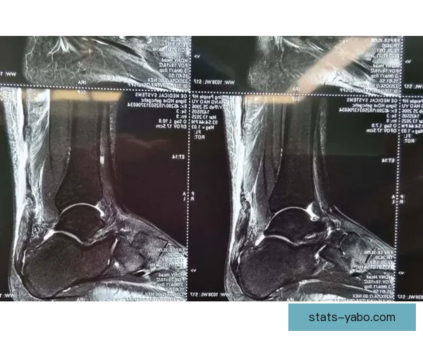 穆迪左膝髌腱撕裂赛季报销 将进入长期康复期